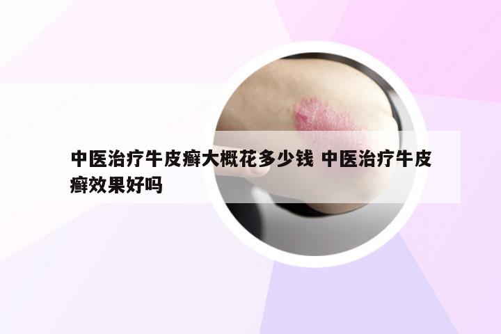 中医治疗牛皮癣大概花多少钱 中医治疗牛皮癣效果好吗