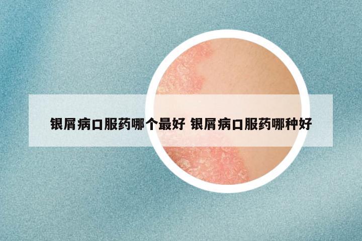 银屑病口服药哪个最好 银屑病口服药哪种好