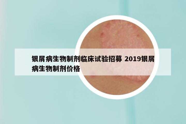 银屑病生物制剂临床试验招募 2019银屑病生物制剂价格