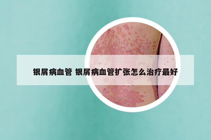 银屑病血管 银屑病血管扩张怎么治疗最好