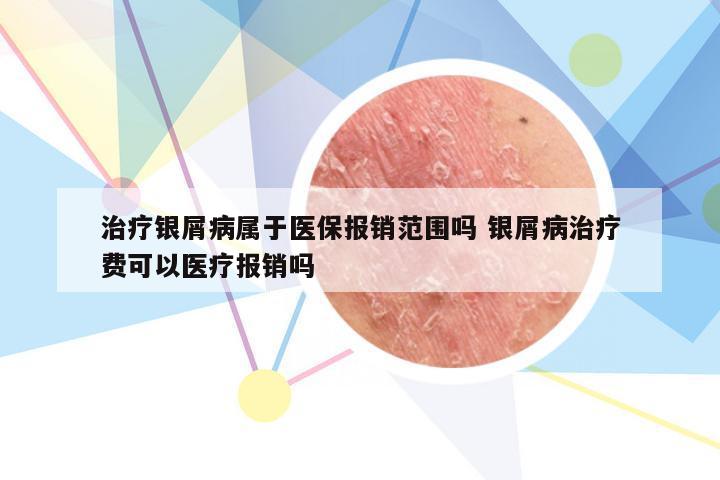 治疗银屑病属于医保报销范围吗 银屑病治疗费可以医疗报销吗