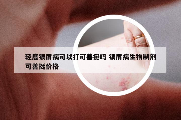 轻度银屑病可以打可善挺吗 银屑病生物制剂可善挺价格