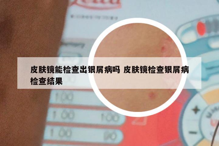 皮肤镜能检查出银屑病吗 皮肤镜检查银屑病检查结果