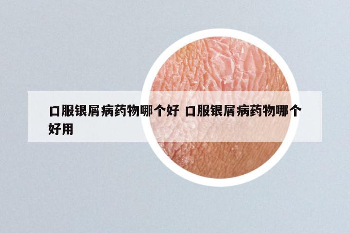 口服银屑病药物哪个好 口服银屑病药物哪个好用