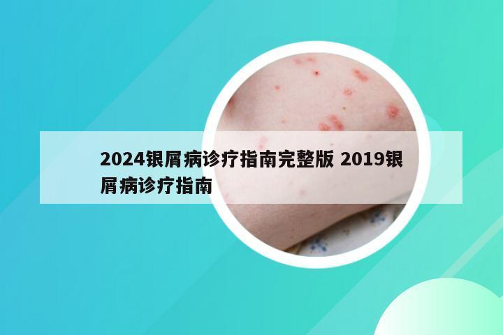 2024银屑病诊疗指南完整版 2019银屑病诊疗指南