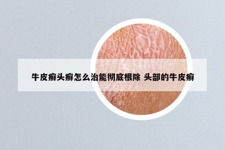 牛皮癣头癣怎么治能彻底根除 头部的牛皮癣