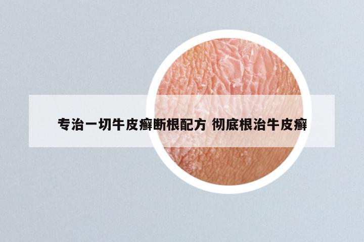 专治一切牛皮癣断根配方 彻底根治牛皮癣