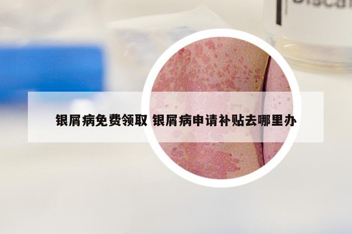 银屑病免费领取 银屑病申请补贴去哪里办