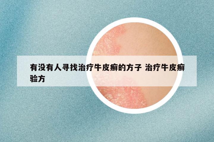 有没有人寻找治疗牛皮癣的方子 治疗牛皮癣验方