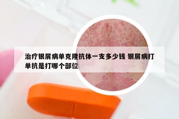 治疗银屑病单克隆抗体一支多少钱 银屑病打单抗是打哪个部位