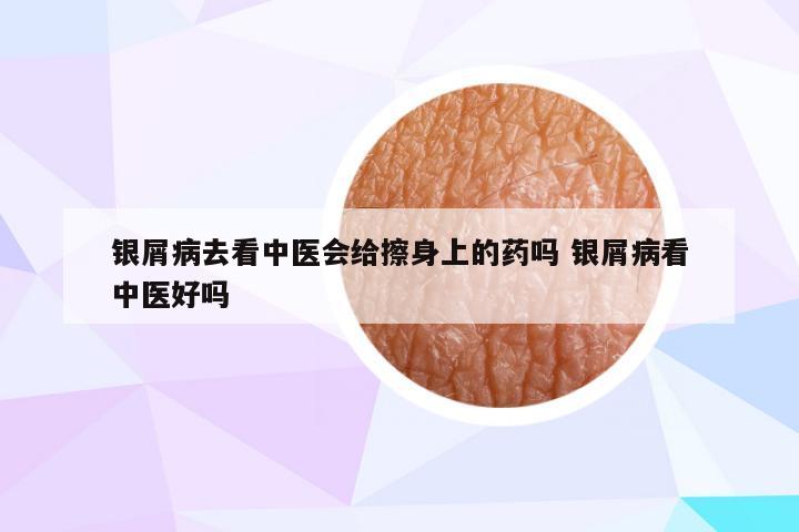 银屑病去看中医会给擦身上的药吗 银屑病看中医好吗