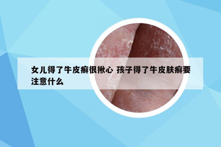 女儿得了牛皮癣很揪心 孩子得了牛皮肤癣要注意什么
