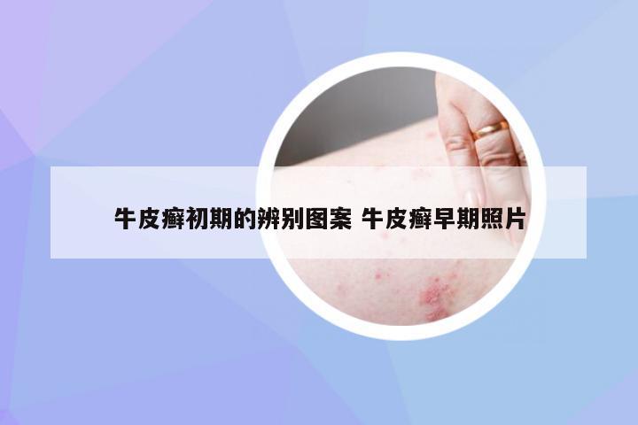 牛皮癣初期的辨别图案 牛皮癣早期照片