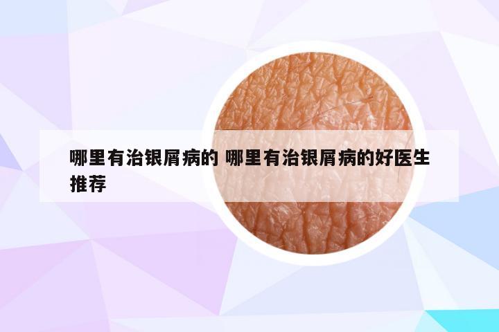 哪里有治银屑病的 哪里有治银屑病的好医生推荐