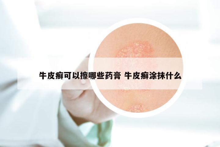 牛皮癣可以擦哪些药膏 牛皮癣涂抹什么