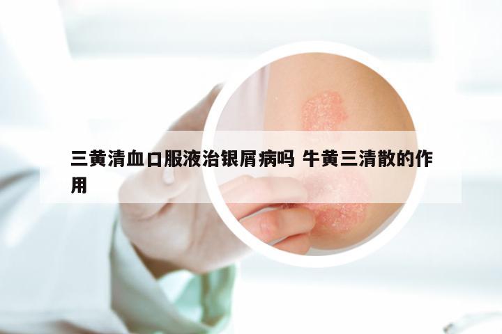三黄清血口服液治银屑病吗 牛黄三清散的作用