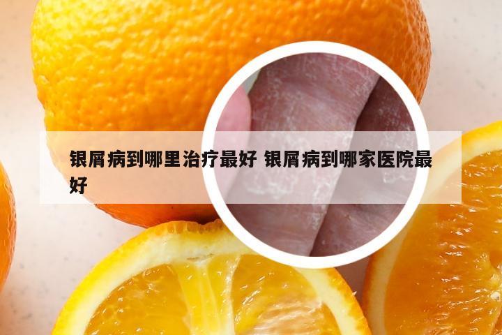 银屑病到哪里治疗最好 银屑病到哪家医院最好