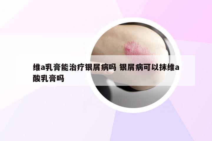 维a乳膏能治疗银屑病吗 银屑病可以抹维a酸乳膏吗