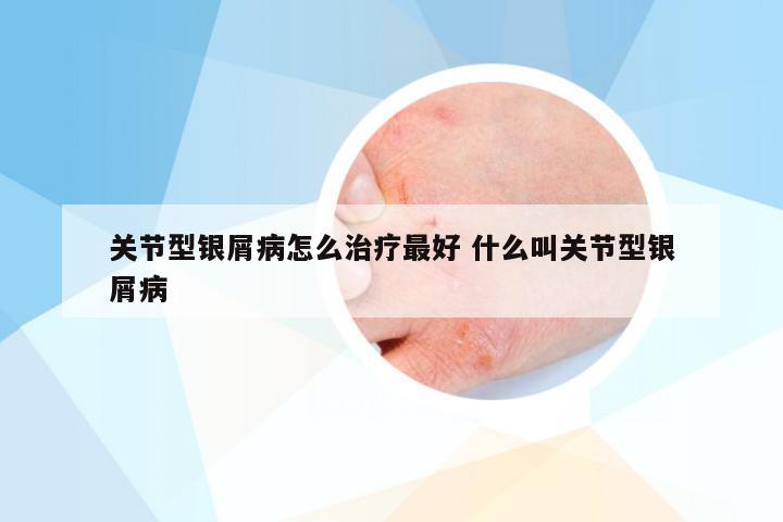 关节型银屑病怎么治疗最好 什么叫关节型银屑病