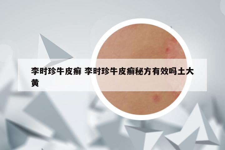 李时珍牛皮癣 李时珍牛皮癣秘方有效吗土大黄