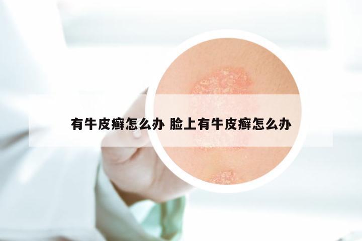 有牛皮癣怎么办 脸上有牛皮癣怎么办