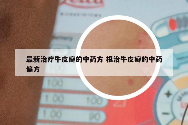 最新治疗牛皮癣的中药方 根治牛皮癣的中药偏方