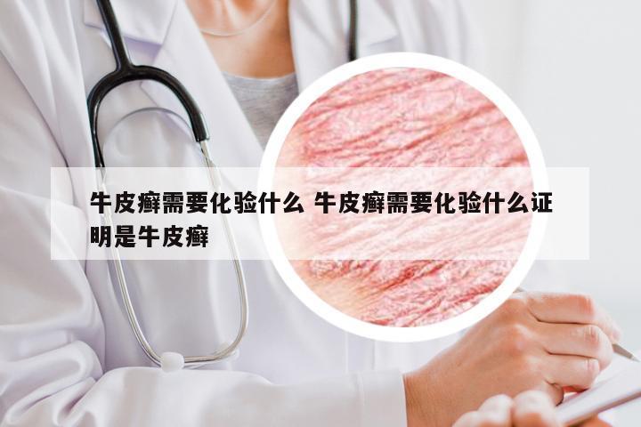 牛皮癣需要化验什么 牛皮癣需要化验什么证明是牛皮癣