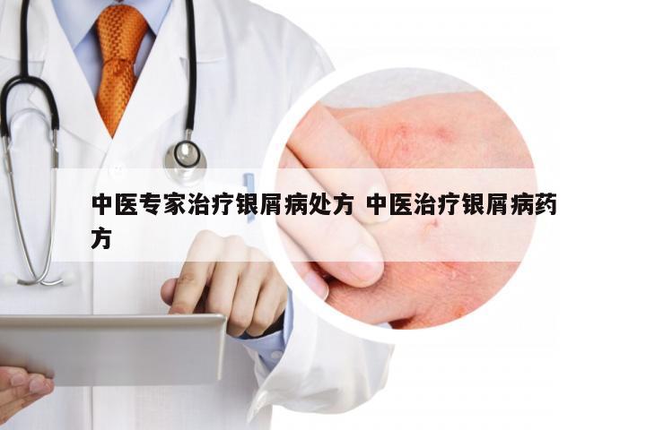 中医专家治疗银屑病处方 中医治疗银屑病药方