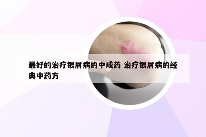 最好的治疗银屑病的中成药 治疗银屑病的经典中药方