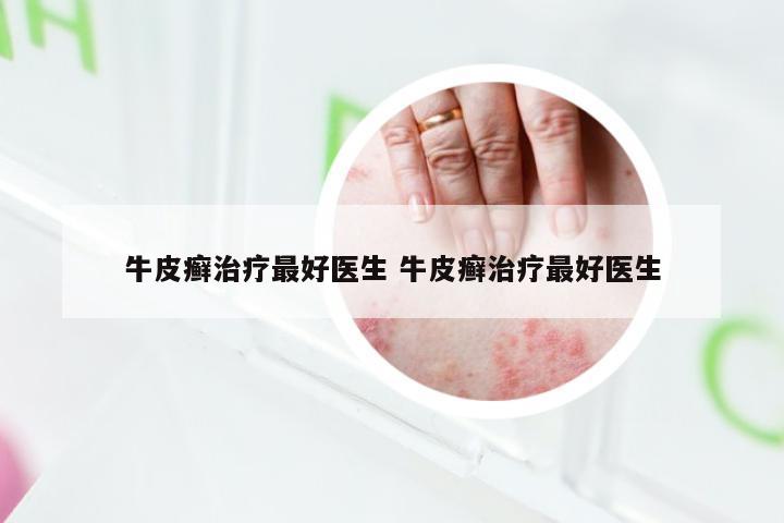 牛皮癣治疗最好医生 牛皮癣治疗最好医生