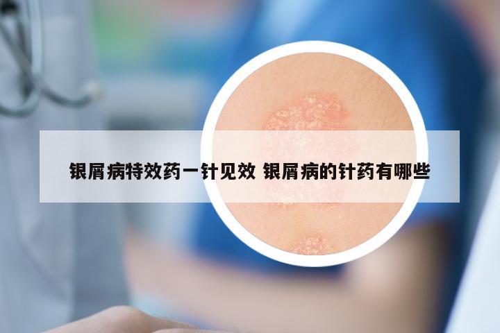 银屑病特效药一针见效 银屑病的针药有哪些