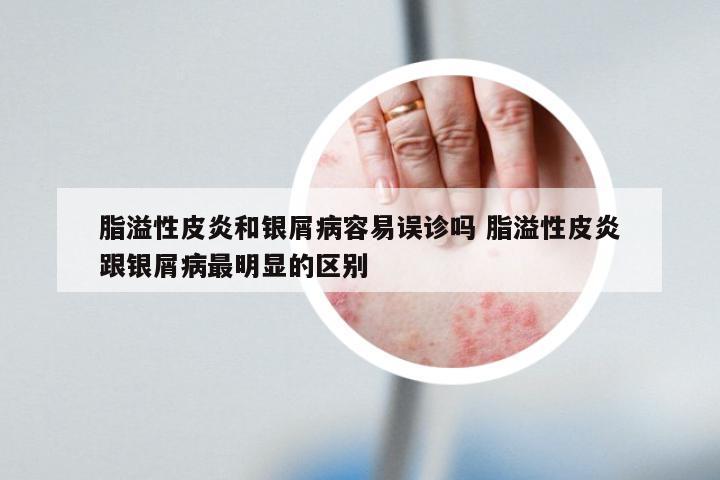 脂溢性皮炎和银屑病容易误诊吗 脂溢性皮炎跟银屑病最明显的区别