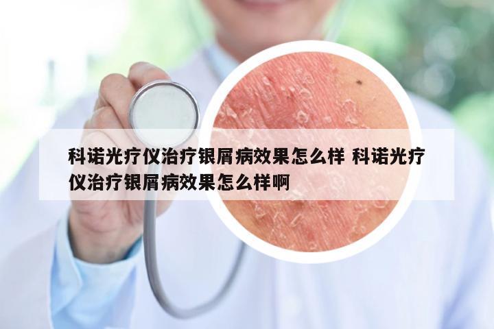 科诺光疗仪治疗银屑病效果怎么样 科诺光疗仪治疗银屑病效果怎么样啊