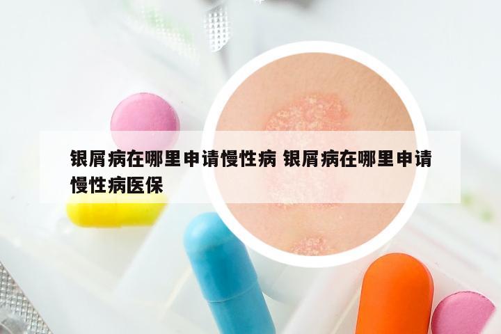 银屑病在哪里申请慢性病 银屑病在哪里申请慢性病医保