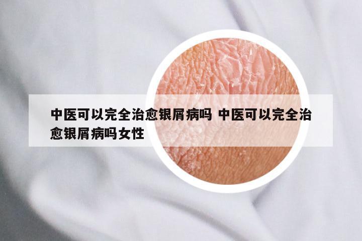 中医可以完全治愈银屑病吗 中医可以完全治愈银屑病吗女性
