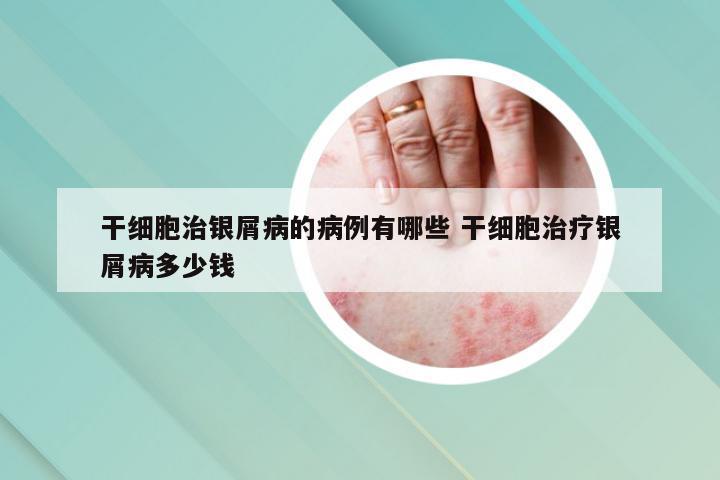 干细胞治银屑病的病例有哪些 干细胞治疗银屑病多少钱
