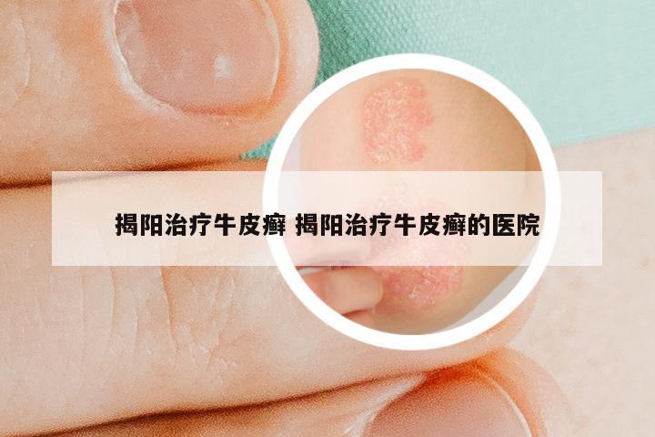揭阳治疗牛皮癣 揭阳治疗牛皮癣的医院