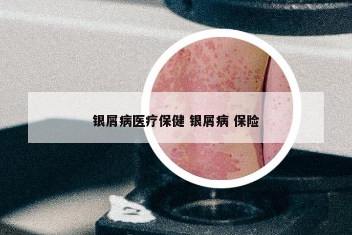 银屑病医疗保健 银屑病 保险