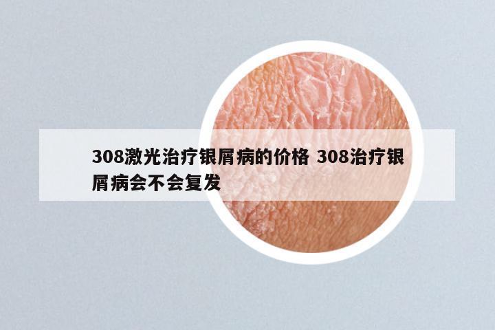 308激光治疗银屑病的价格 308治疗银屑病会不会复发