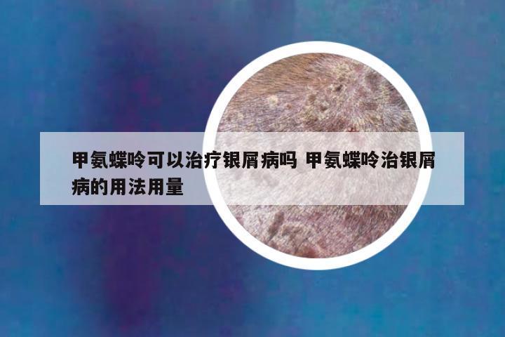 甲氨蝶呤可以治疗银屑病吗 甲氨蝶呤治银屑病的用法用量