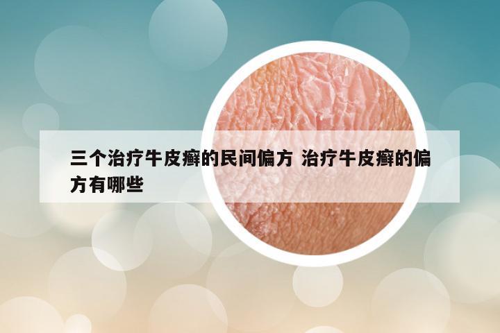 三个治疗牛皮癣的民间偏方 治疗牛皮癣的偏方有哪些