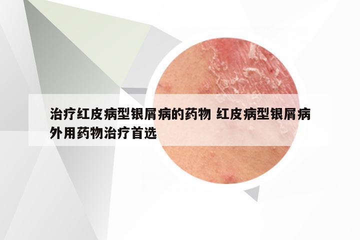 治疗红皮病型银屑病的药物 红皮病型银屑病外用药物治疗首选