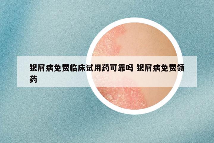 银屑病免费临床试用药可靠吗 银屑病免费领药