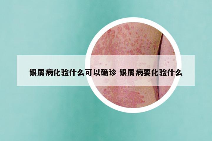银屑病化验什么可以确诊 银屑病要化验什么