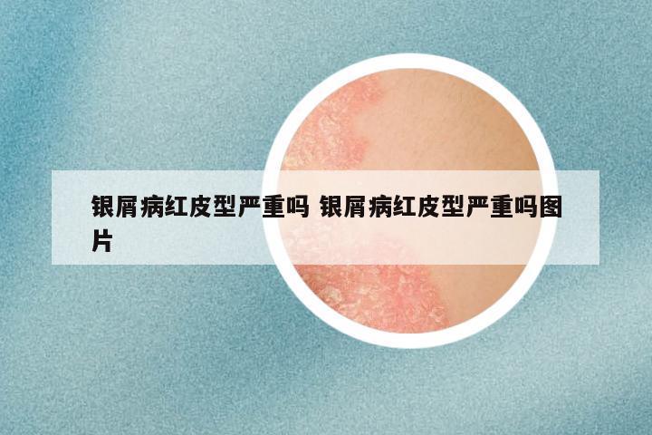 银屑病红皮型严重吗 银屑病红皮型严重吗图片