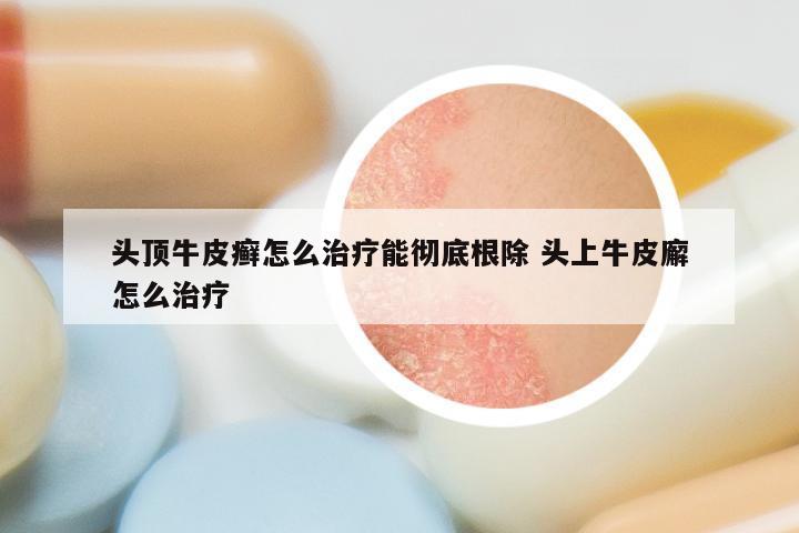 头顶牛皮癣怎么治疗能彻底根除 头上牛皮廨怎么治疗