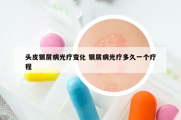 头皮银屑病光疗变化 银屑病光疗多久一个疗程