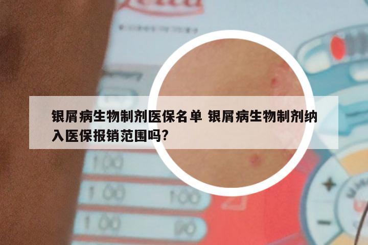 银屑病生物制剂医保名单 银屑病生物制剂纳入医保报销范围吗?