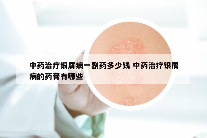 中药治疗银屑病一副药多少钱 中药治疗银屑病的药膏有哪些
