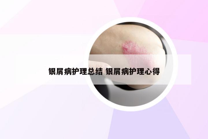 银屑病护理总结 银屑病护理心得